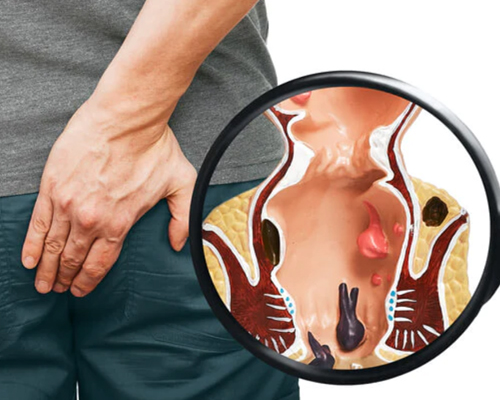 Piles (Hemorrhoids)