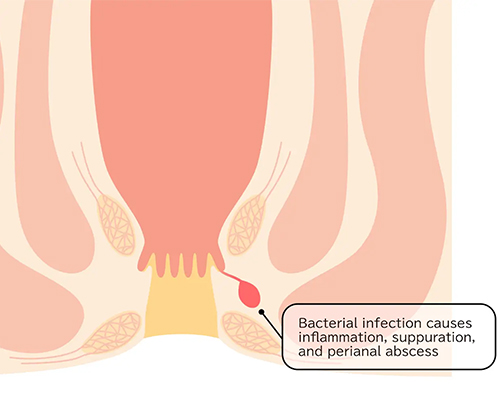 Anal Abscess