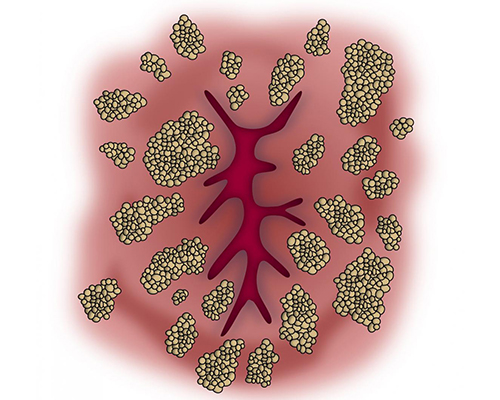 Anal Warts